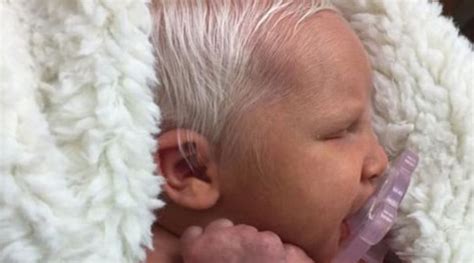 This Is How This Baby Is Born With White Hair The Nurse Had Never Seen