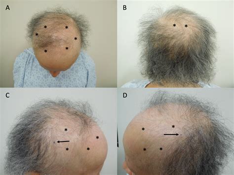 Cureus Persistent Alopecia In A Breast Cancer Patient Following