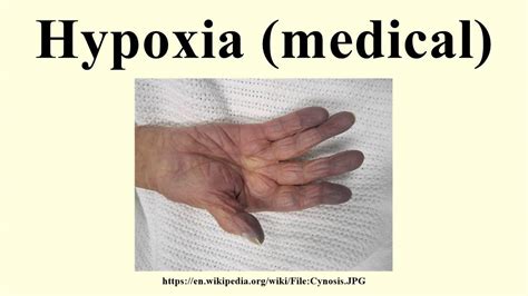 Hypoxia Medical Youtube