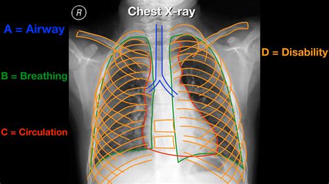 Read And Interpret Chest X Rays The Abcde Mnemonic Step By Step Practice Ezmed