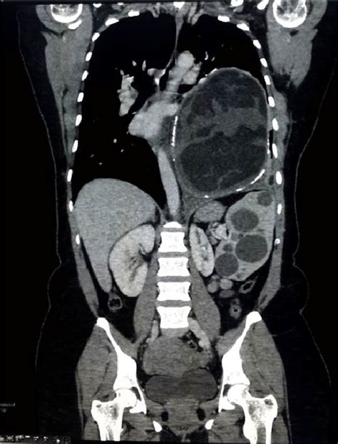 Coronal View Of Ct Scan Of The Chestabdomenpelvis Download