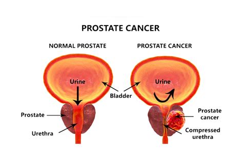 Of The Most Common Prostate Conditions And Their Causes