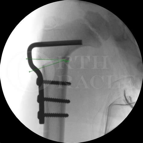 Congenital Dislocation Of The Hip Proximal Femoral Varus Osteotomy