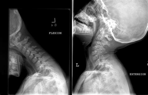 A Flexion And B Extension Cervical Spine X Rays Sho Open I