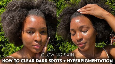 How I Cleared My Acne Hyperpigmentation And Dark Spots 5 Best Products