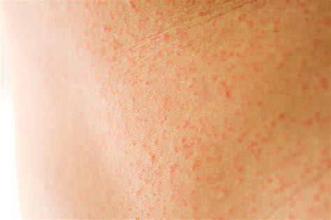 Welt Rash Stock Photos Pictures And Royalty Free Images Istock