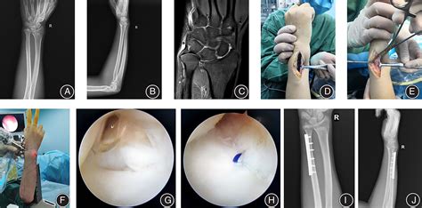 Clinical Study Of Wrist Arthroscopy Combined With Oblique Ulnar