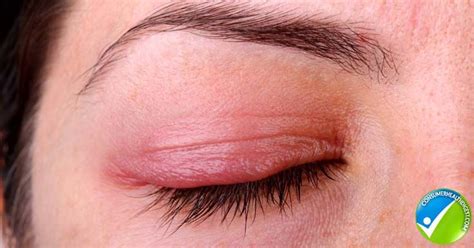 Flaky Skin Around Eyes Know All Symptoms Causes And Treatments Here