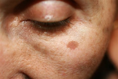Brown Spots On Face Melasma