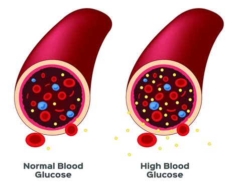What Is High Blood Sugar
