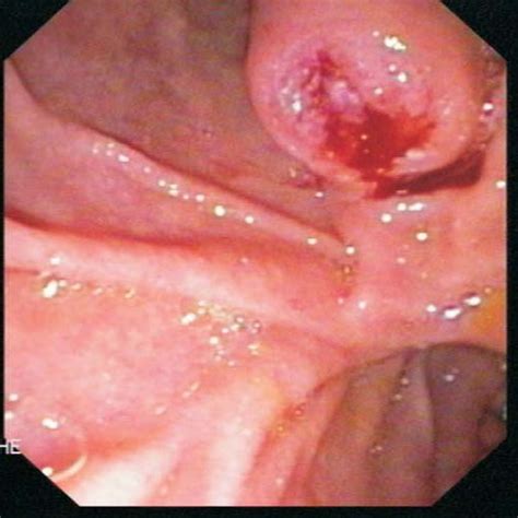 Upper Gastrointestinal Endoscopy Revealing An Ulcerated Ampullary Tumour Download Scientific
