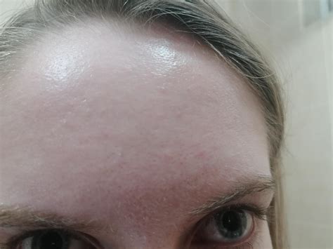 Skin Concern How Do I Get Rid Of These Little Bumps On My Forehead Rrosacea