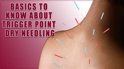 What To Expect From Reliable Trigger Point Dry Needling Expert Guide