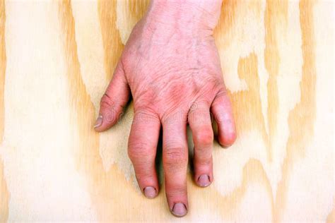 Rheumatoid Arthritis Hands Stock Image Image Of Disability 72668059
