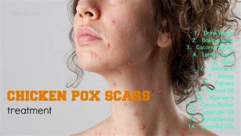 Chicken Pox Scars Treatment 18 Useful Tips