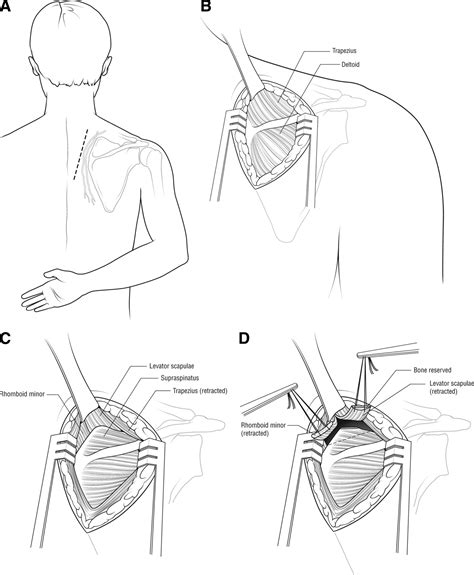The Snapping Scapula Diagnosis And Treatment Arthroscopy