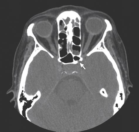 Chronic Sphenoid Sinusitis Revisited Comparison Of Multidetector Axial