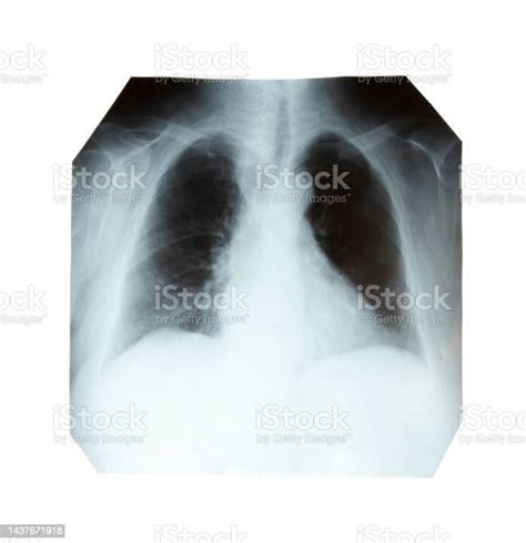 Chest Xray Isolated On A White Background Stock Photo Download Image