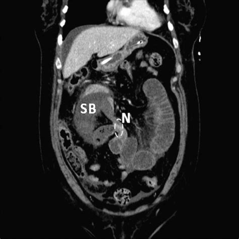 Case Of A Strangulated Right Paraduodenal Fossa Hernia In A Malrotated Gut BMJ Case Reports