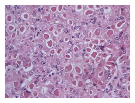 Eosinophilic Cytoplasmic Inclusions With Globular Appearance And