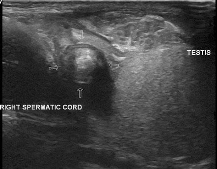 Whirlpool Sign Testicular Torsion Radiology Reference Article