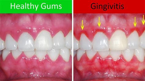 A New Way To Treat Gum Disease Perioscopy Green City Dental