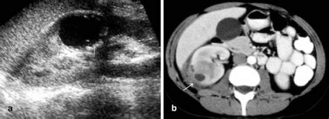 A B Renal Abscess A Longitudinal Us Scan Of The Right Kidney Shows A