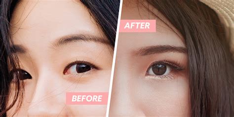 Double Eyelid Surgery In Singapore Plastic Surgeon Shares What You