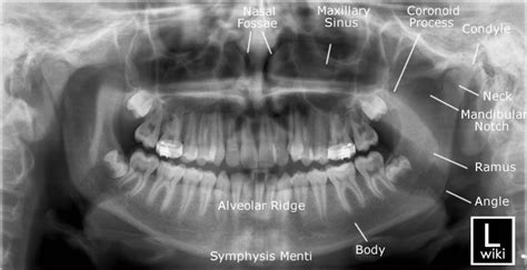 Mandible Radiographic Anatomy Wikiradiography Facial Bones