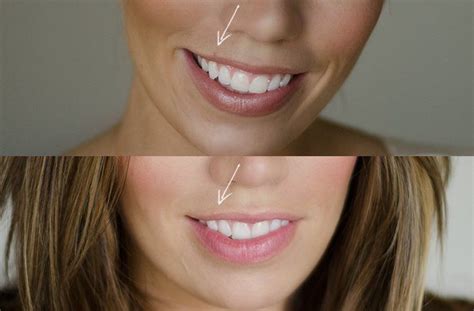 Cherry angiomas are found mainly on the trunk and proximal extremities (figure 1); Tip Tuesday: One Quick Zap | Maskcara, Covering acne, Maskcara beauty