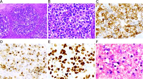 Extranodal Nkt Cell Lymphoma Histologic Sections Of A Nasal Cavity