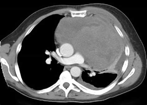 Surgical Management Of Primary Mediastinal Germ Cell Tumors Ctsnet