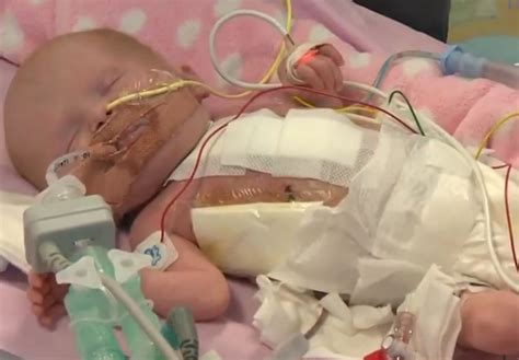 Newborn With Heart Outside Chest Survives Surgery World News Asiaone