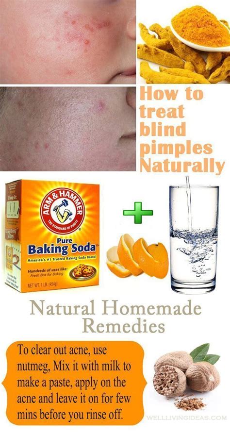 15 Natural Homemade Remedies To Treat Blind Pimples