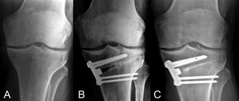 ¿cómo Se Lleva A Cabo La Osteotomía Tibial Fisioonline