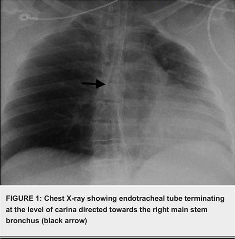 Figure 1 From An Unusual Case Of Iatrogenic Tracheal Diverticulum Found