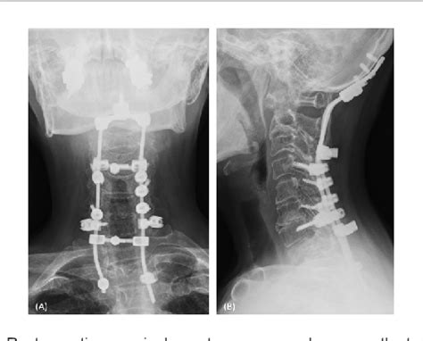 Figure 3 From A Case Of Occipito Thoracic Fusion For Skull Base And