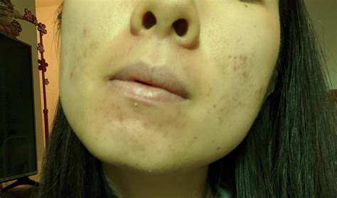 Acne Been Dealing With Persistent Lower Cheekchin Acne For Over A