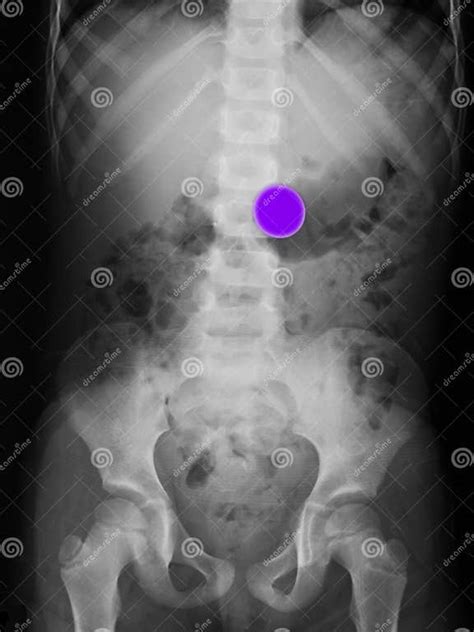 X Ray Of A Child Who Swallowed A Coin Stock Photo Image Of Accidental