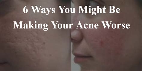 6 Ways You Might Be Making Your Acne Worse