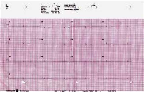 Ecg Pre Operative Severe Bradycardia Download Scientific Diagram