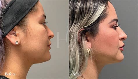 Buccal Fat Removal In Orlando — Hz Plastic Surgery