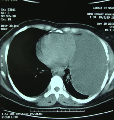 A Pitfall In The Diagnosis Of Giant Bronchogenic Cyst Presented As
