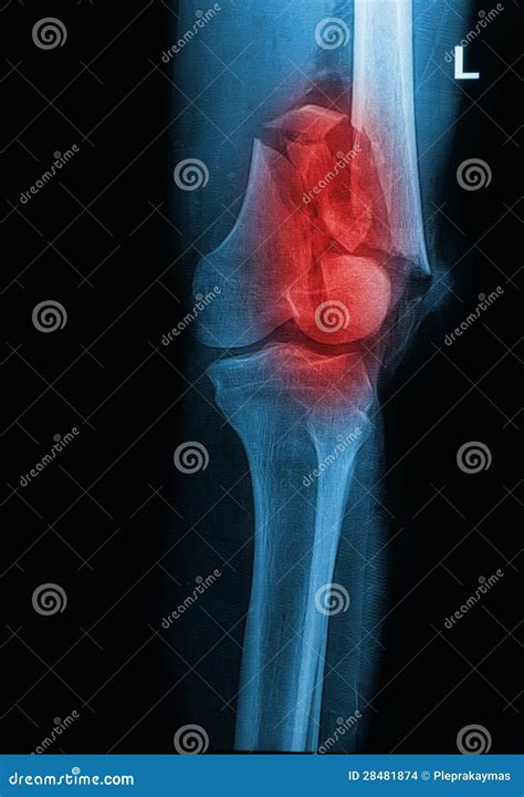 Broken Human Thigh X Rays Image Stock Images Image 28481874