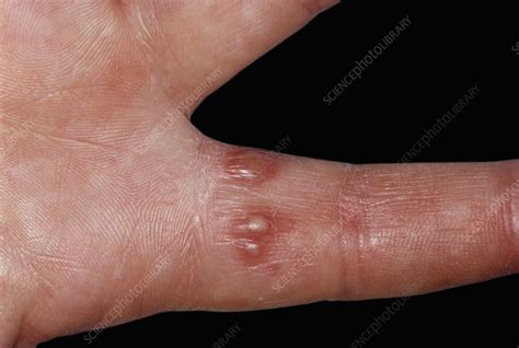 Herpes Whitlow Infection Stock Image C0509949 Science Photo Library