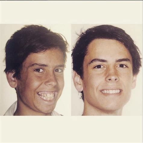 Drastic Transformations Of People Before And After Braces Braces