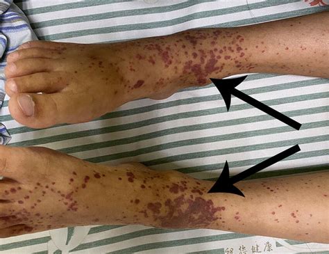 Typical Palpable Purpura On The Lower Limbs Download Scientific Diagram