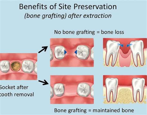 Oral Surgery Bone Grafts Lake Lanier Smiles