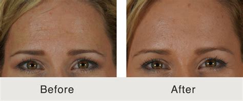 Before And After Botox Carolina Facial Plastics