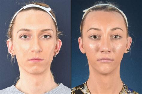 Facial Feminization Surgery Brow Lift Feminizing The Eyebrows 2pass Clinic
